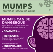 Mumps Mumps